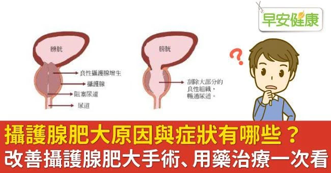 攝護腺肥大患者用藥示意圖